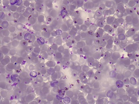 Plasmodium falciparum (malaria) in a blood slide